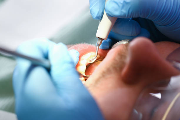 Best Emergency Dental Care for Abscessed Tooth in East Hemet, CA